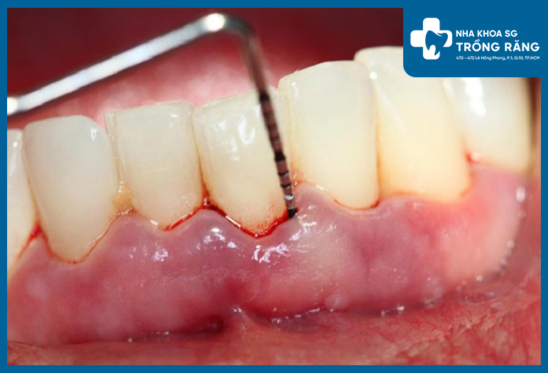 nhiem trung chan rang 1