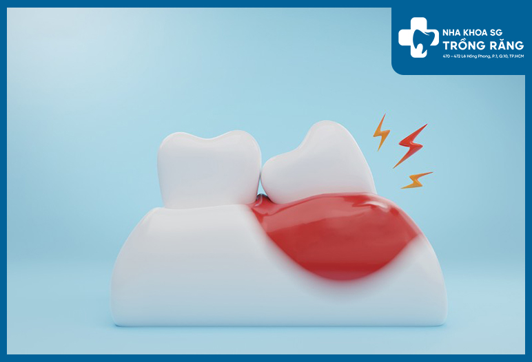 nhiem trung chan rang 4