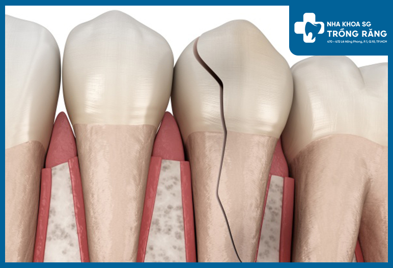 Nứt răng, gãy thân răng có thể do nhiều yếu tố
