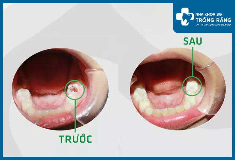 Phương pháp điều trị nứt và gãy chân răng sẽ phụ thuộc vào mức độ và vị trí tổn thương