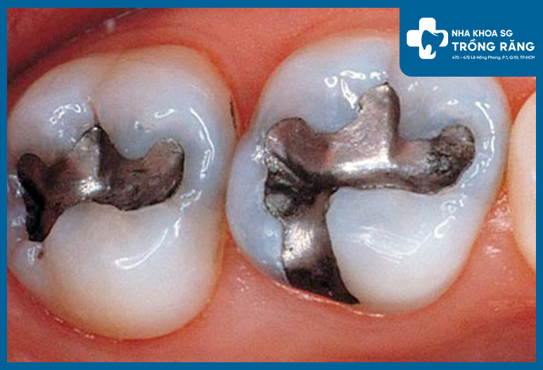 Trám răng cũng là một trong phương pháp giúp phục hồi hư tổn ở chân răng