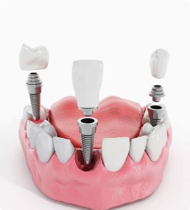 trong rang implant la gi 2