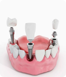 trong rang implant la gi 2