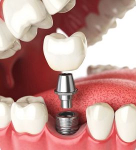 trong rang implant la gi