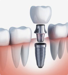 trong rang implant la gi 3