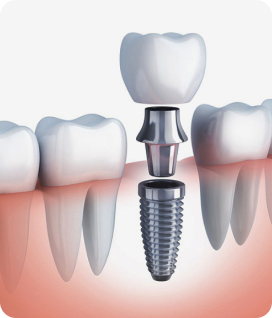 trong rang implant la gi 3