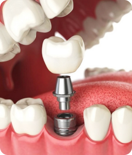 trong rang implant la gi