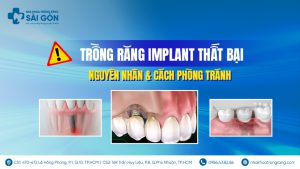 trồng răng implant thất bại