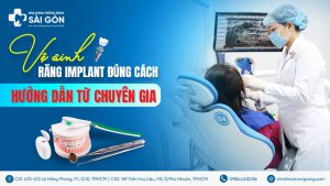 vệ sinh răng implant