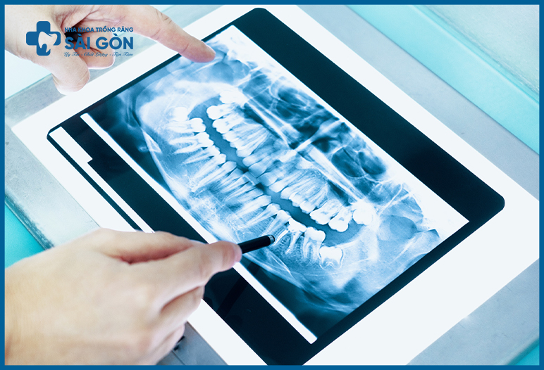 phim x-quang toàn cảnh