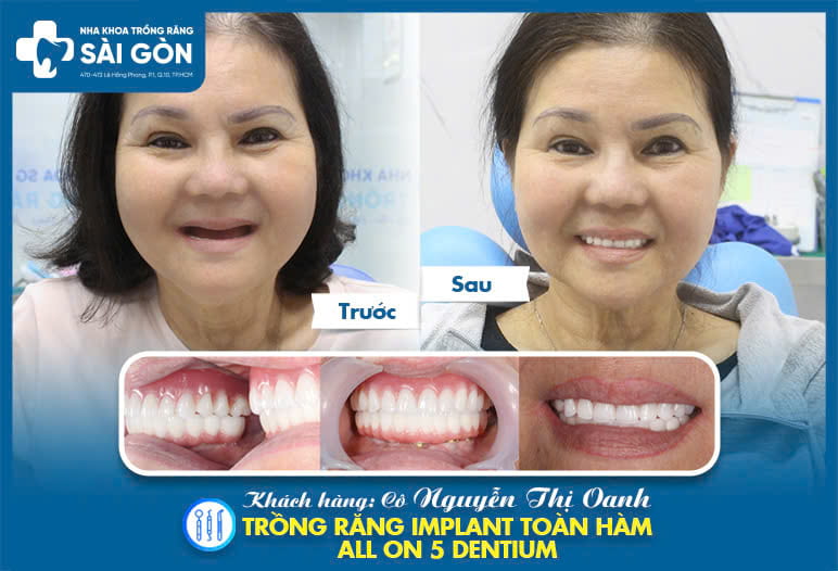 trồng răng implant detium hàn quốc