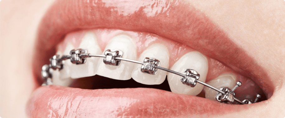 nieng rang tham my 1