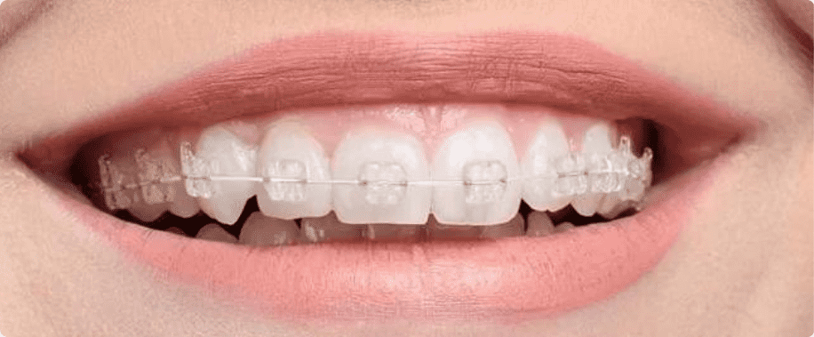 nieng rang tham my 2