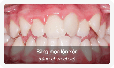 niềng răng lộn xộn