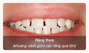 niềng răng thưa