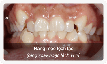 niềng răng mọc lộn xộn