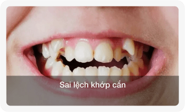 niềng răng sai khớp cắn