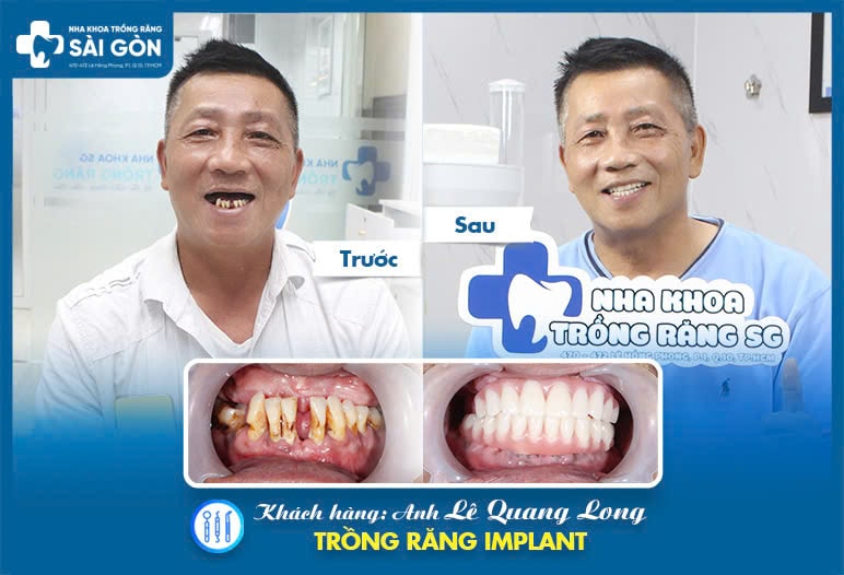 tru implant detium han quoc 1 6