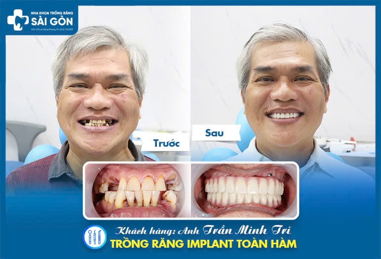 khách hàng implant Detium Hàn Quốc