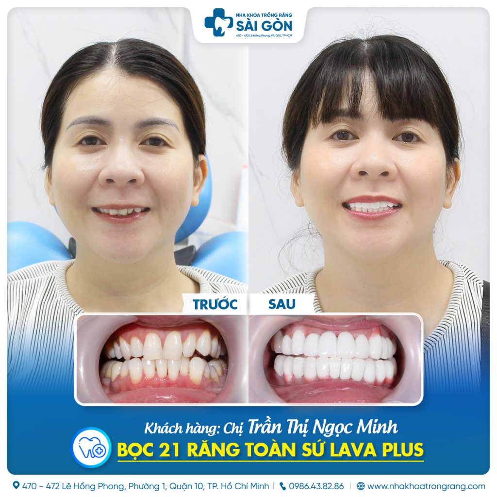 Tran Thi Ngoc Minh 21 rang su Lava Plus