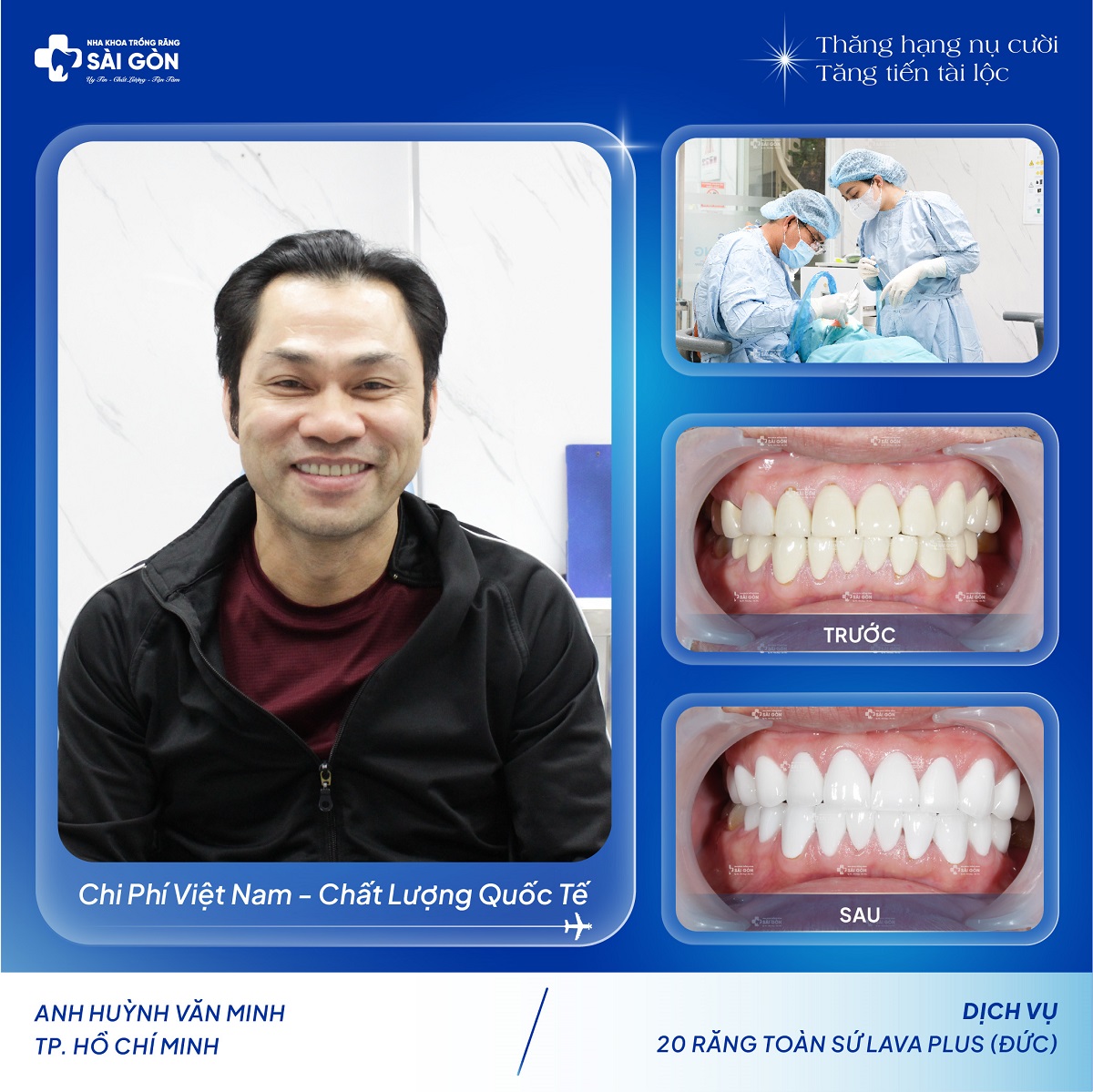 anh huynh van minh boc 20 rang su lava plus duc Anh Huỳnh Văn Minh Bọc 20 Răng Sứ Lava Plus của Đức