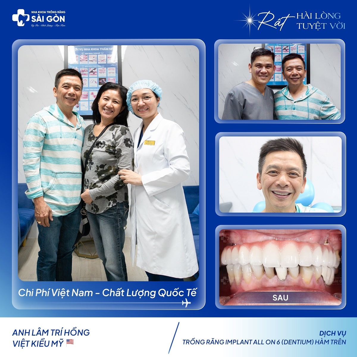 Anh Lâm Trí Hồng Việt Kiều Mỹ trồng răng implant All On 6 Dentium (Hàm Trên)