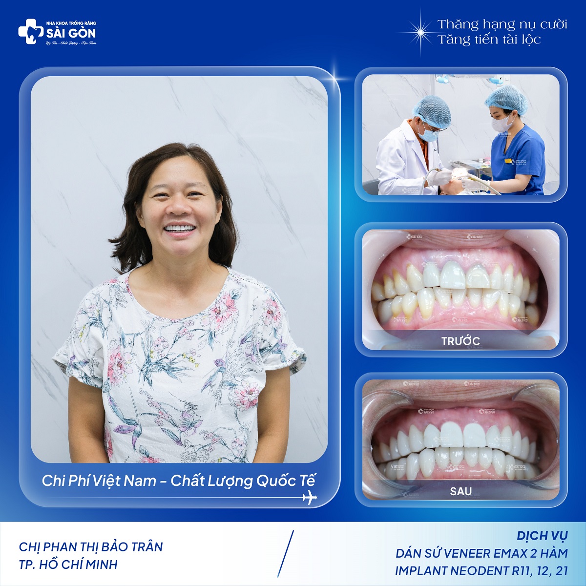 chi phan thi bao tran dan su veneer 2 ham Chị Phan Thị Bảo Trân Dán Sứ Veneer Emax 2 Hàm