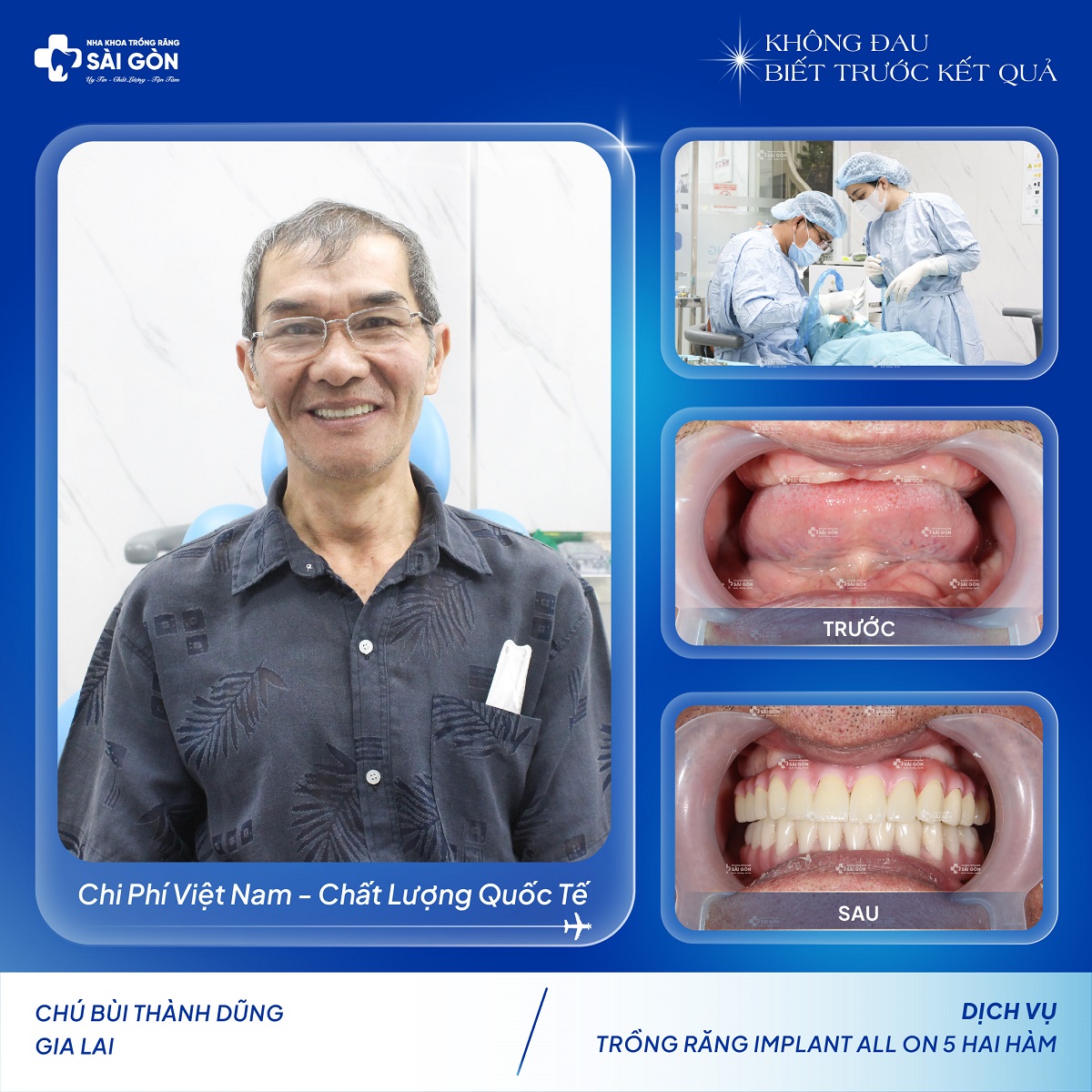 Chú Bùi Thành Dũng trồng răng implant all on 5 hai hàm