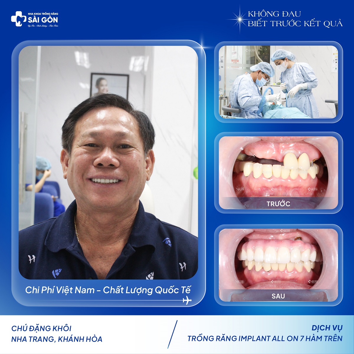Chú Đặng Khôi trồng răng implant all on 7 hàm trên