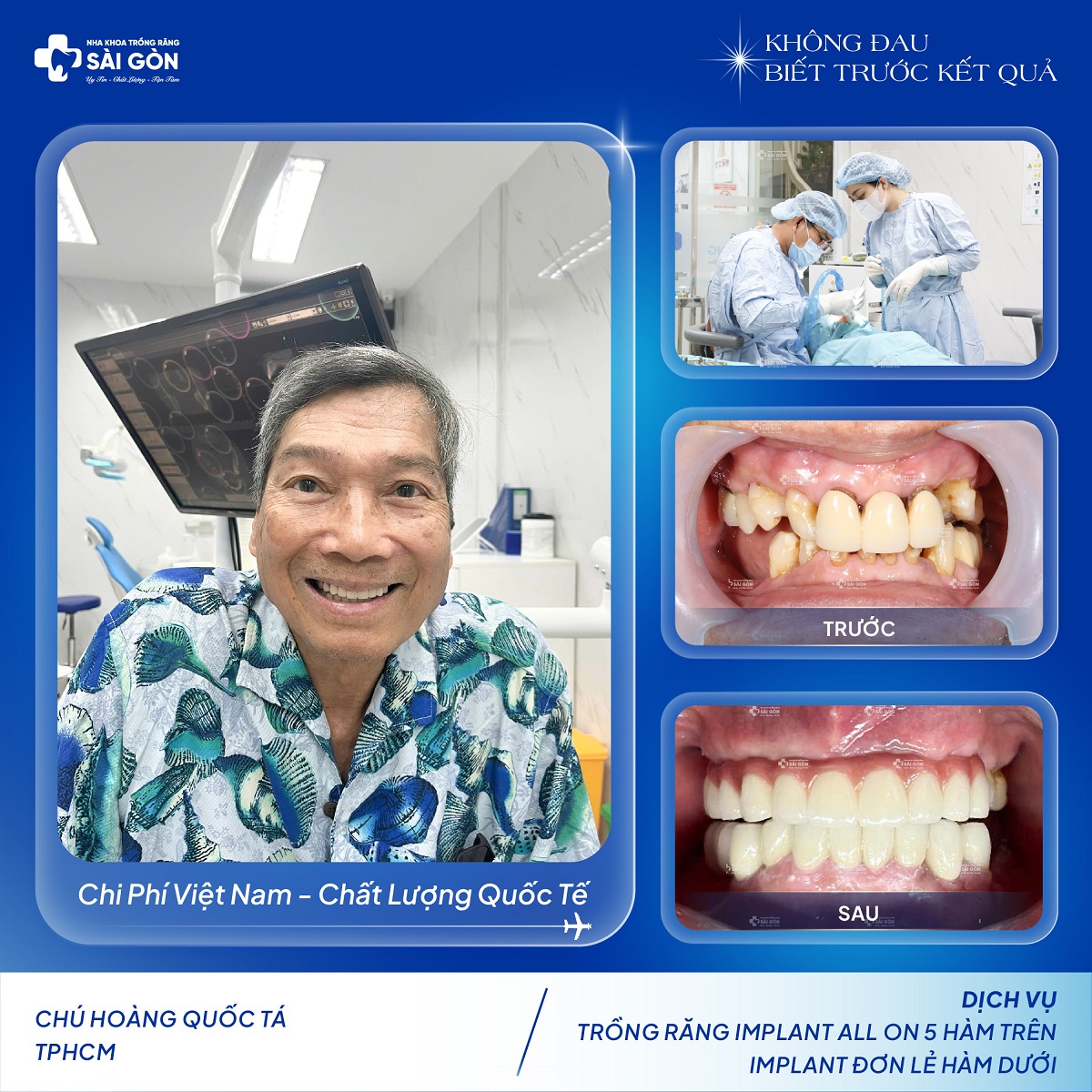 Chú Hoàng Quốc Tá Trồng Răng Implant All On 5 Hàm Trên Và Implant Đơn Lẻ Hàm Dưới tại Nha Khoa Trồng Răng Sài Gòn