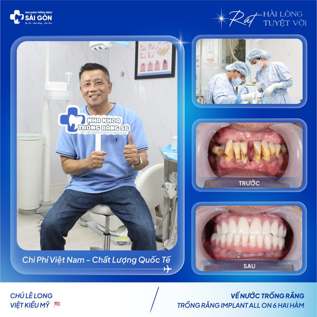 Chú Lê Long Việt Kiều Mỹ Về Nước Trồng Răng Implant All On 2 Hàm