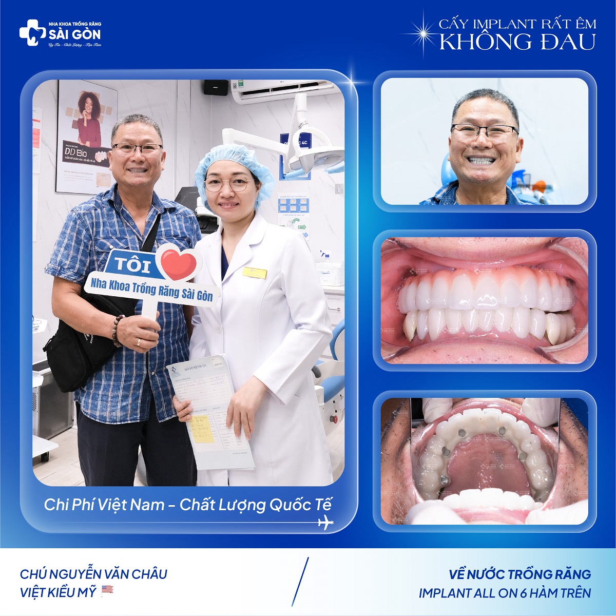 Chú Nguyễn Văn Châu trồng răng Implant All On 6 Hàm Trên