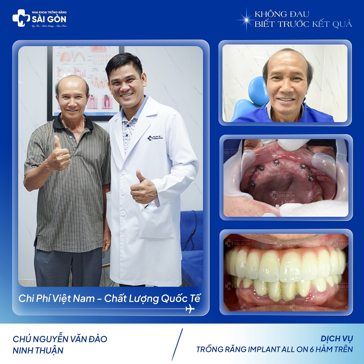 Chú Nguyễn Văn Đào trồng răng implant all on 6 hàm trên
