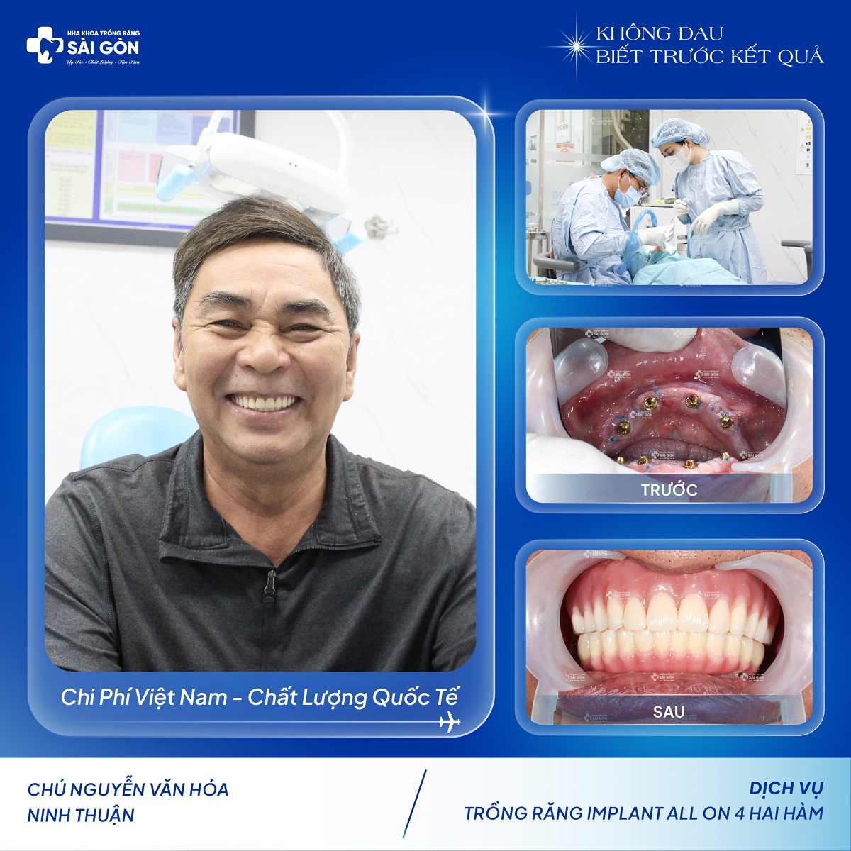 Chú Nguyễn Văn Hóa Trồng Răng Implant All On 4 Hai Hàm.