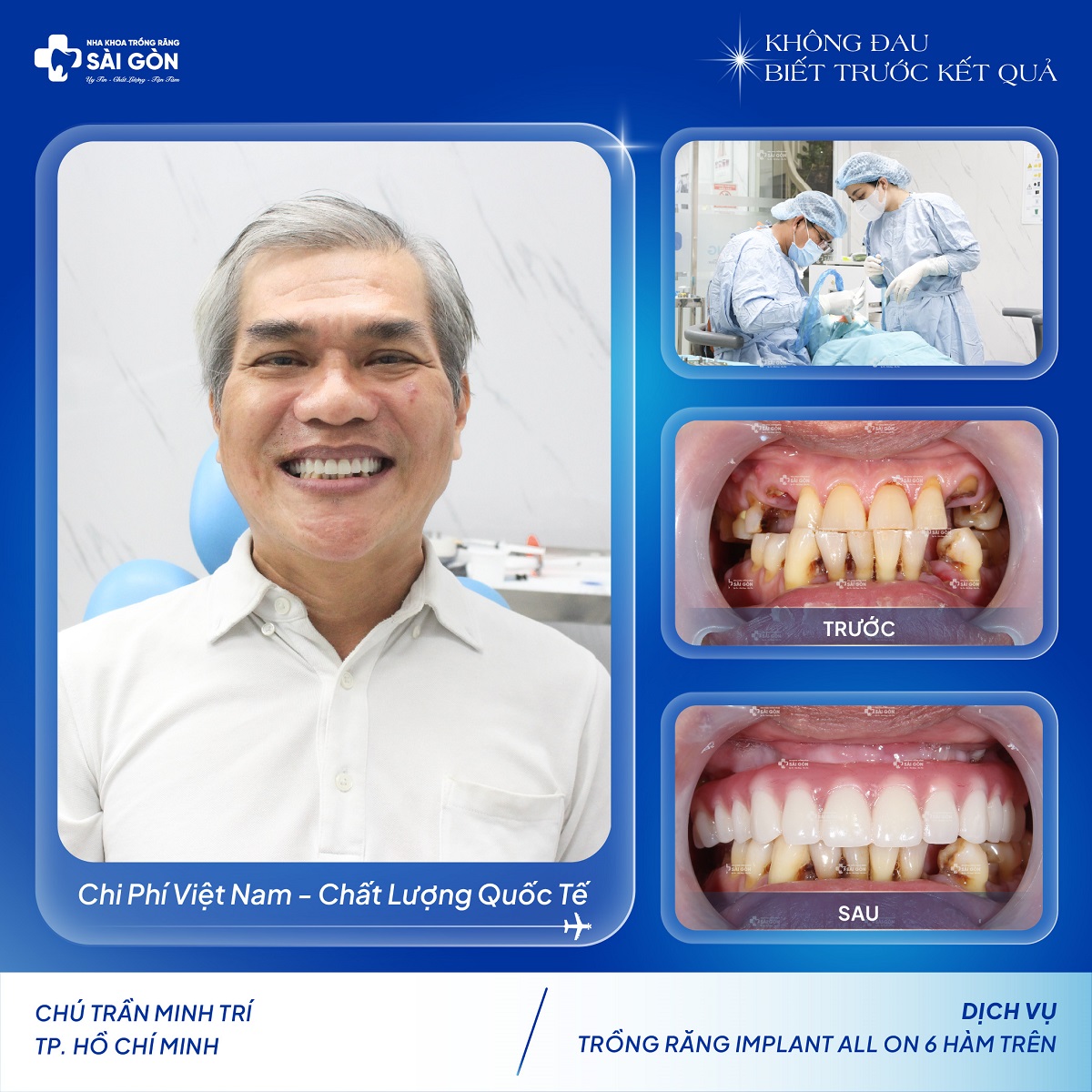 Chú Trần Minh Trí Trồng Răng Implant All On 6 Hàm Trên
