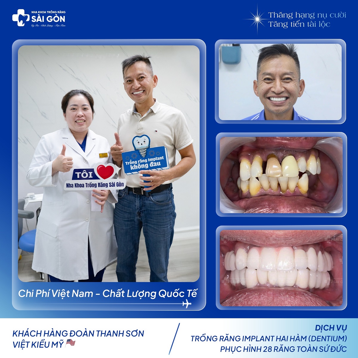 Chúc mừng anh Đoàn Thanh Sơn hoàn thành gắn sứ trên implant