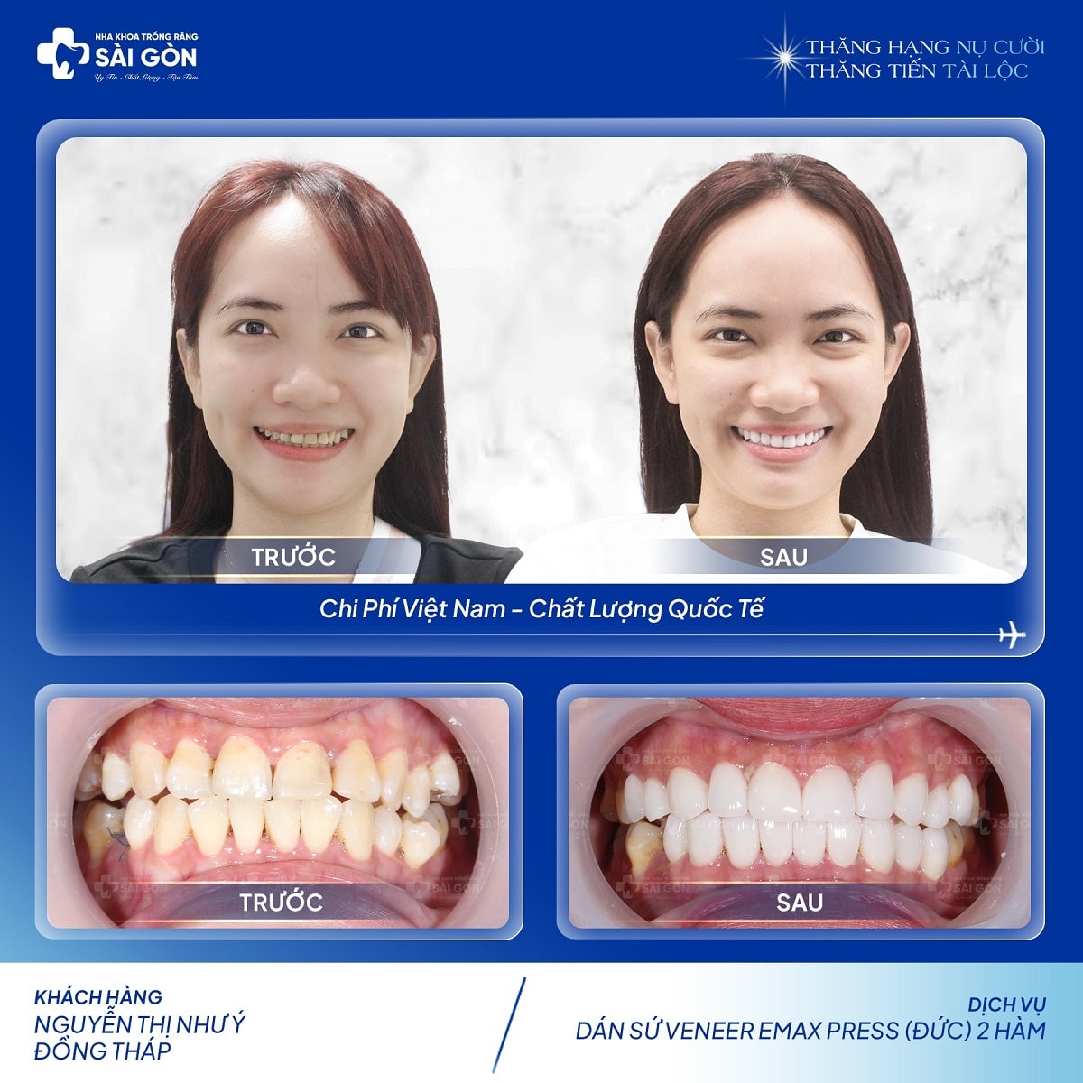 Khách hàng Nguyễn Thị Như Ý dán sứ veneers emax hai hàm