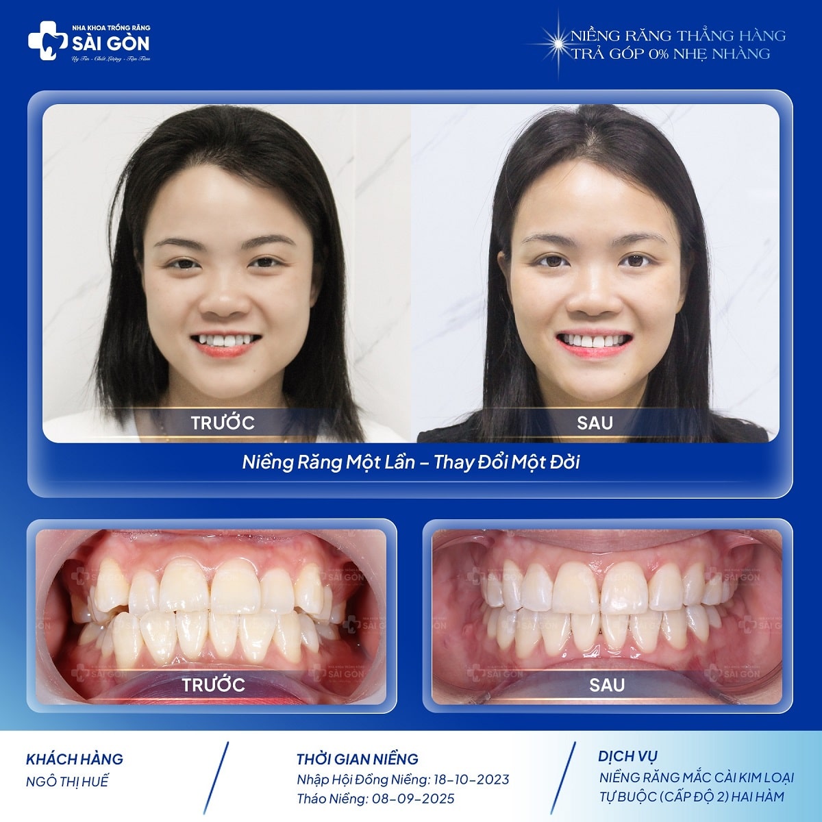 chuc mung khach hang ngo thi hue thao nieng Khách hàng Ngô Thị Huế niềng răng mắc cài kim loại tự buộc