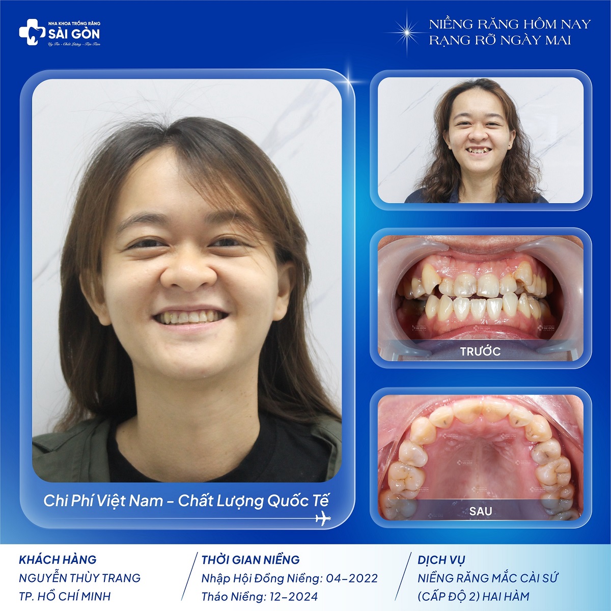 chuc mung khach hang nguyen thuy trang thao nieng 1 Khách hàng tháo niềng mắc cài sứ thẩm mỹ