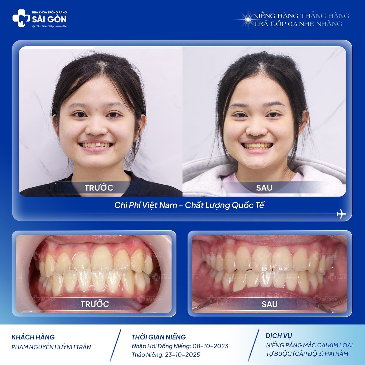 chuc mung thao nieng pham nguyen huynh tran Phạm Nguyễn Huỳnh Trân - Niềng răng mắc cài kim loại tự buộc (cấp độ 3) hai hàm