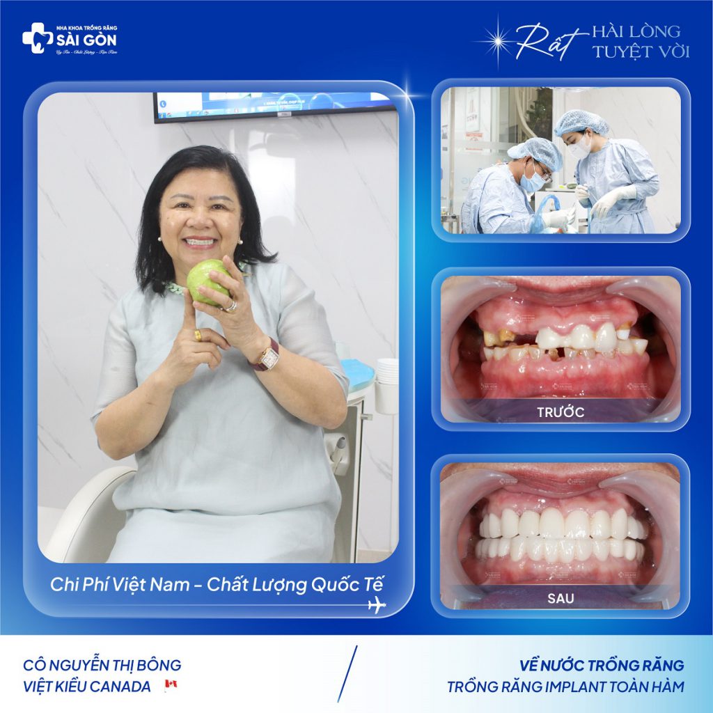 Cô Nguyễn Thị Bông Việt Kiều Canada Về Nước Trồng Răng Implant Toàn Hàm