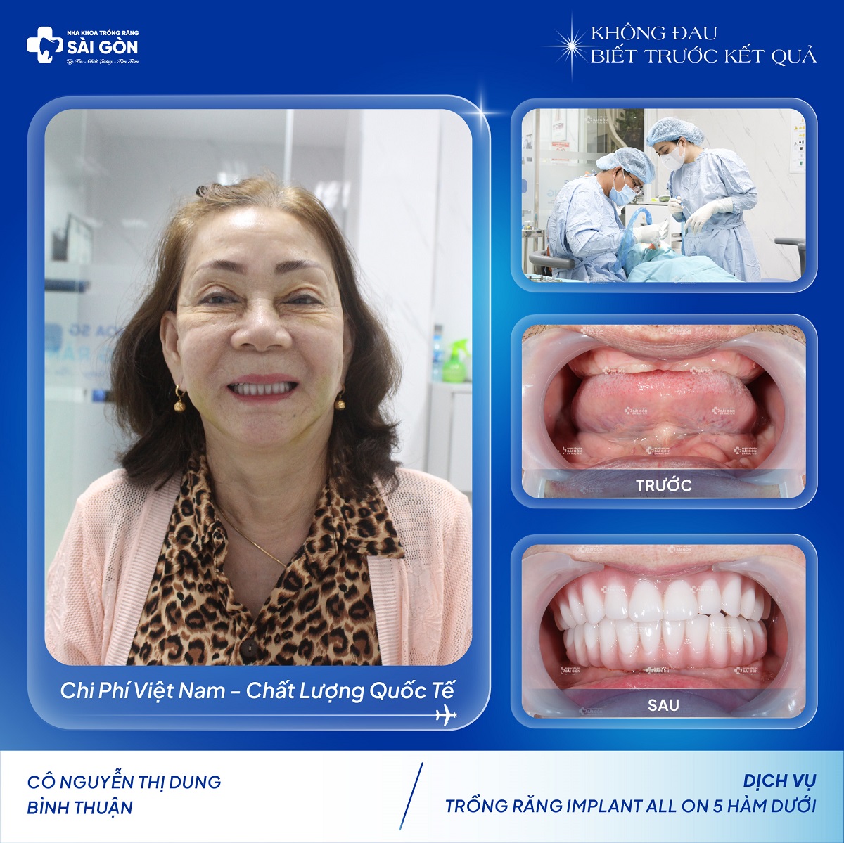 Cô Nguyễn Thị Dung trồng răng implant all on 5 hàm dưới