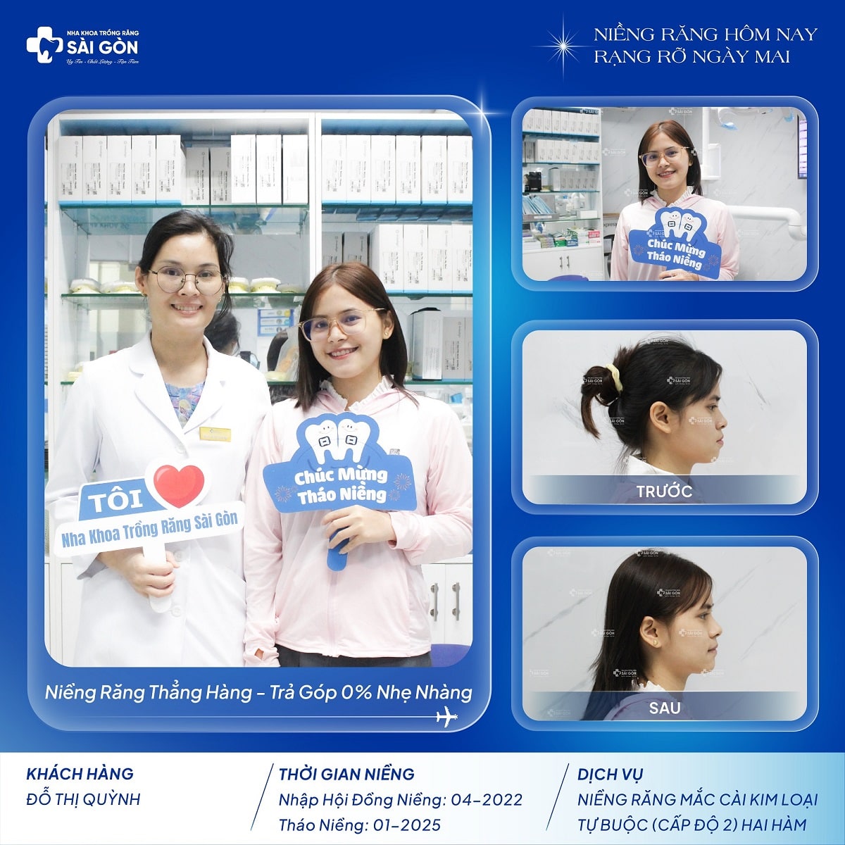 do thi quynh nieng rang mac cai kim loai tu buoc cap do 2 hai ham Đỗ Thị Quỳnh niềng răng mắc cài kim loại tự buộc cấp độ 2 hai hàm tại Nha Khoa Trồng Răng Sài Gòn