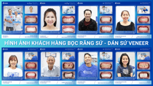 Hình ảnh khách hàng bọc răng sứ và dán sứ veneer tại Nha Khoa Trồng Răng Sài Gòn