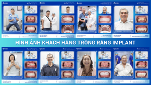Hình ảnh khách hàng trồng răng implant tại Nha Khoa Trồng Răng Sài Gòn