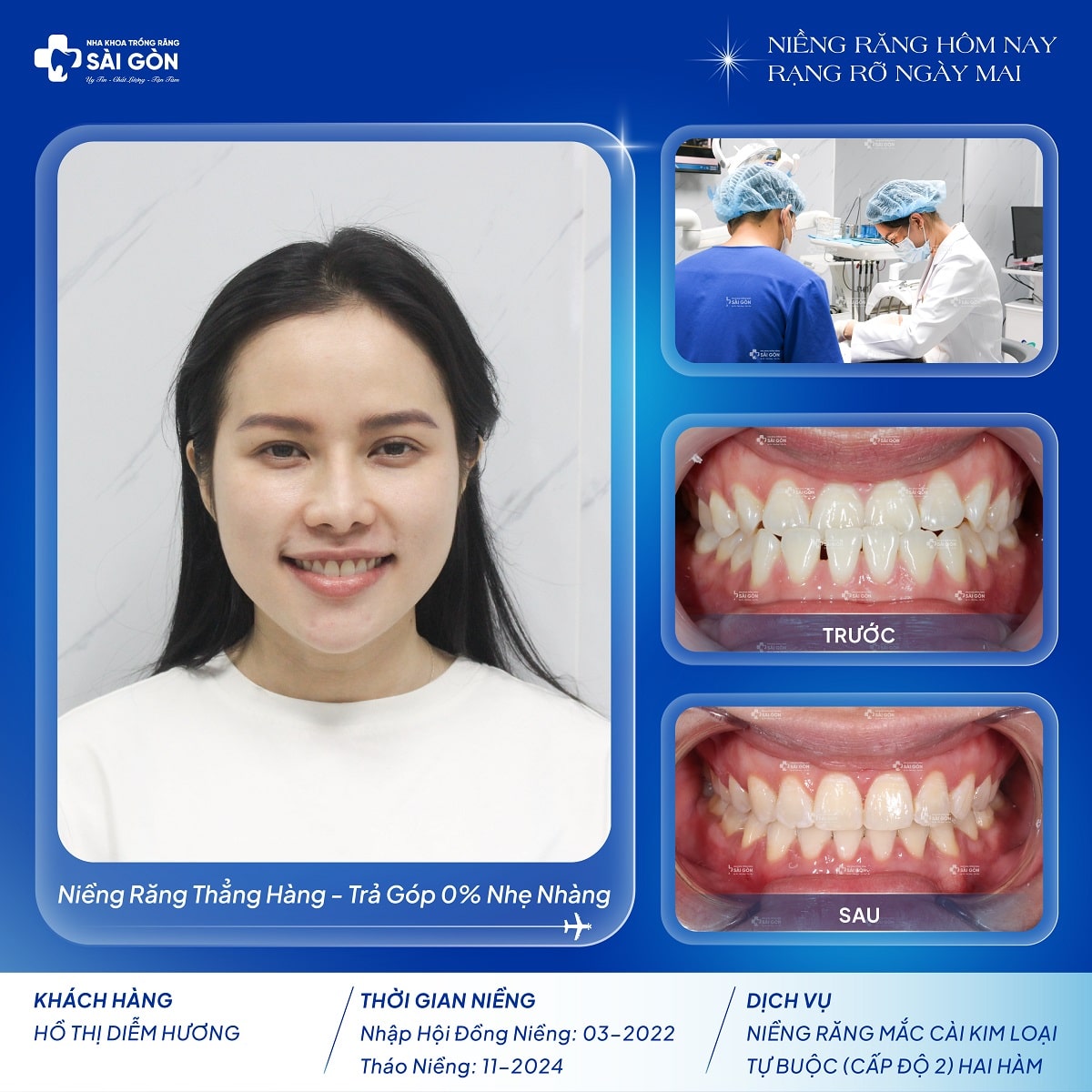ho thi diem huong thao nieng nha khoa trong rang sai gon Chị Hồ Thị Diễm Hương niềng răng mắc cài kim loại tự buộc (cấp độ 2) tại Nha Khoa Trồng Răng Sài Gòn