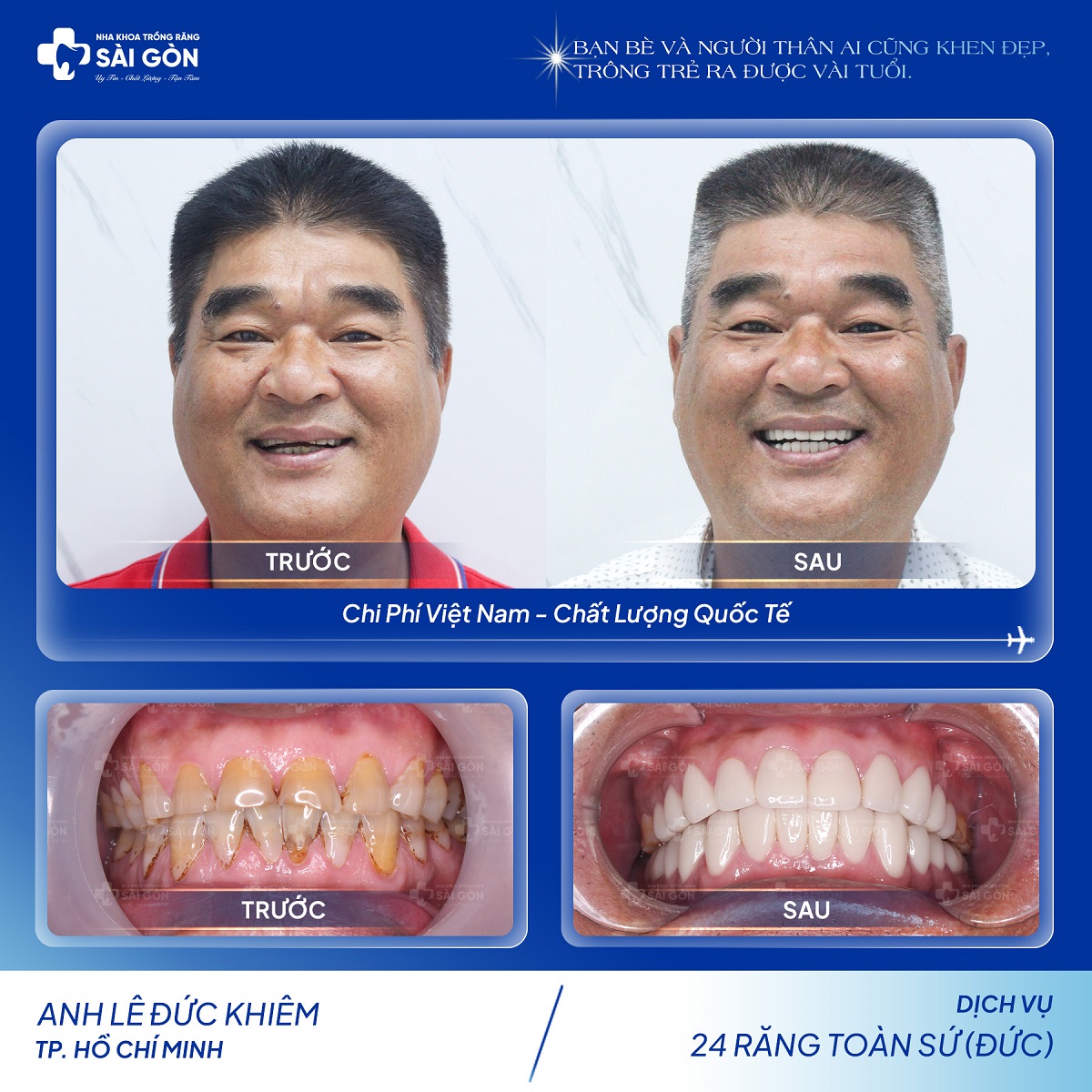 Khách hàng bọc răng sứ - Anh Lê Đức Khiêm bọc 24 răng toàn sứ (Đức)