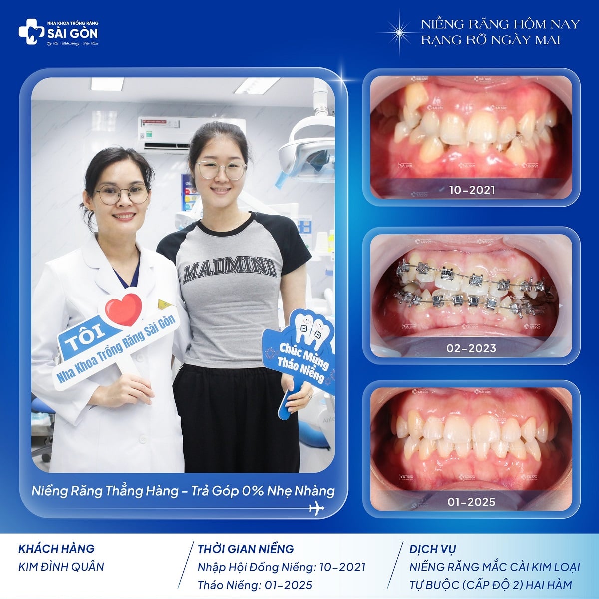 kim dinh quan nieng rang mac cai kim loai tu buoc cap do 2 hai ham Kim Đình Quân niềng răng mắc cài kim loại tự buộc cấp độ 2 tại Nha Khoa Trồng Răng Sài Gòn