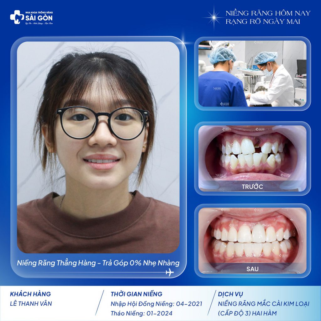Lê Thanh Vân niềng răng mắc cài kim loại cấp độ 3
