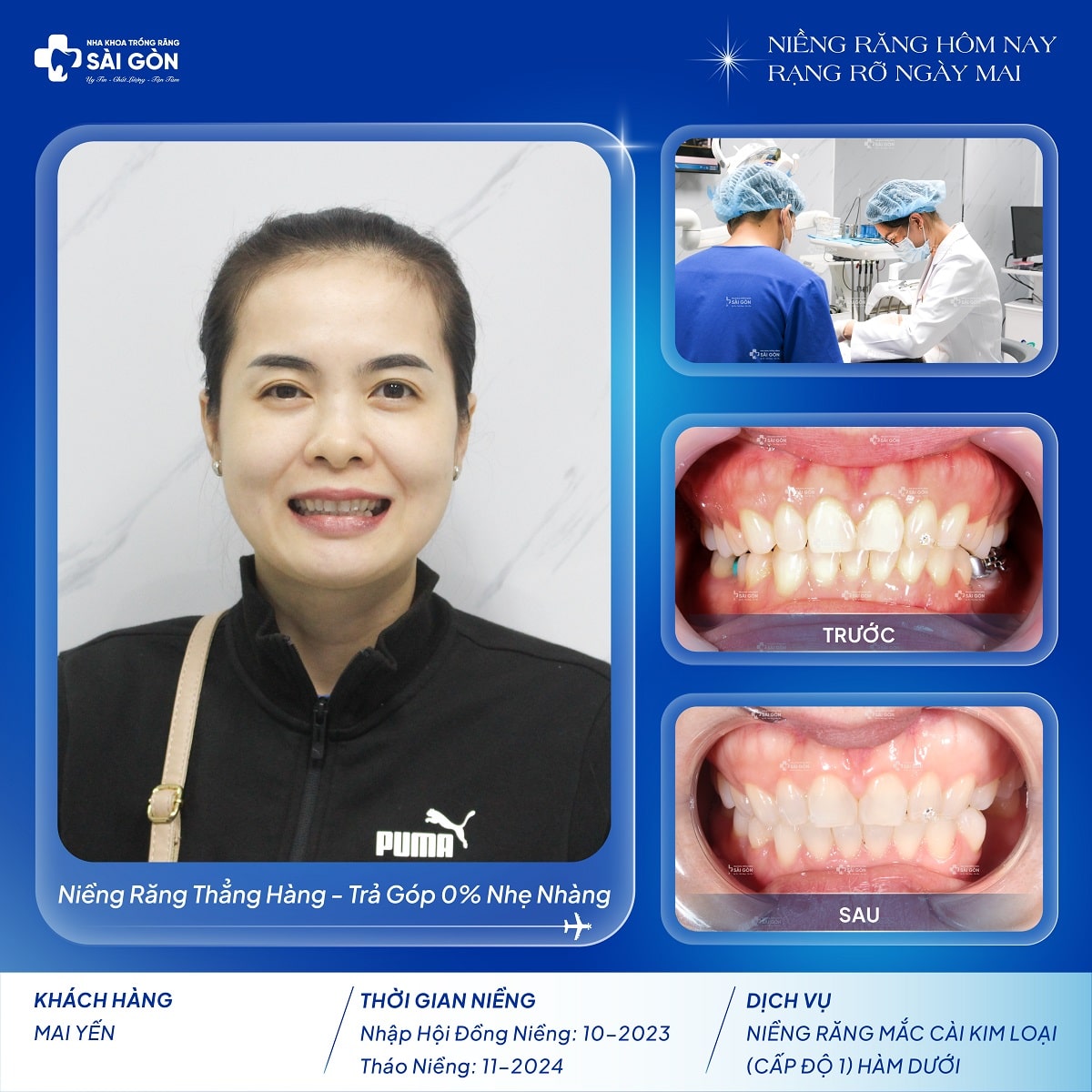 mai yen thao nieng nha khoa trong rang sai gon Chị Mai Yến niềng răng mắc cài kim loại (cấp độ 1) hàm dưới tại Nha Khoa Trồng Răng Sài Gòn
